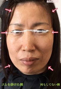 輪ゴムでリフトアップ