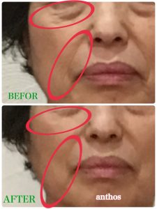 ブラシケアでシワが薄くなった