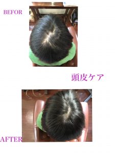 頭皮ケア