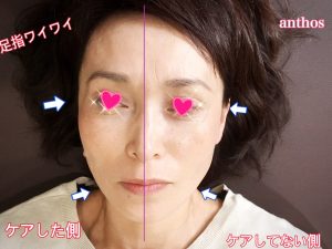 足指ワイワイ症例