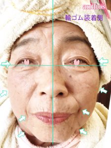 輪ゴムケア症例